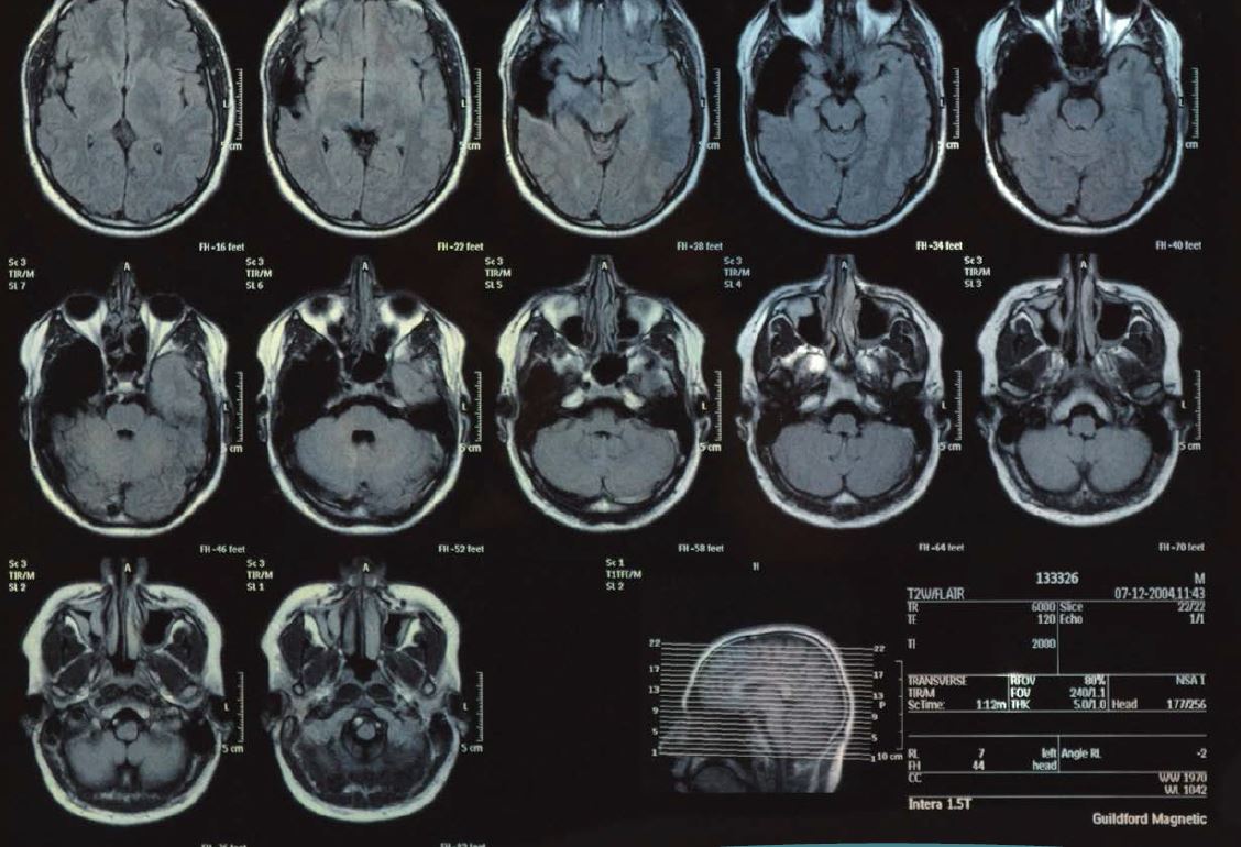 Deep Learning Brain Tumour Image Classification using CNN